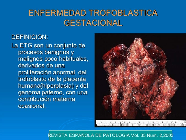enfermedad trofoblastica gestacional